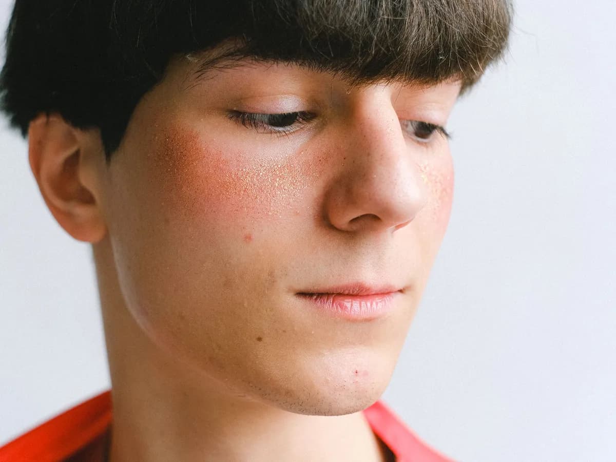 Close-up of a young man's cheek showing marks left by acne