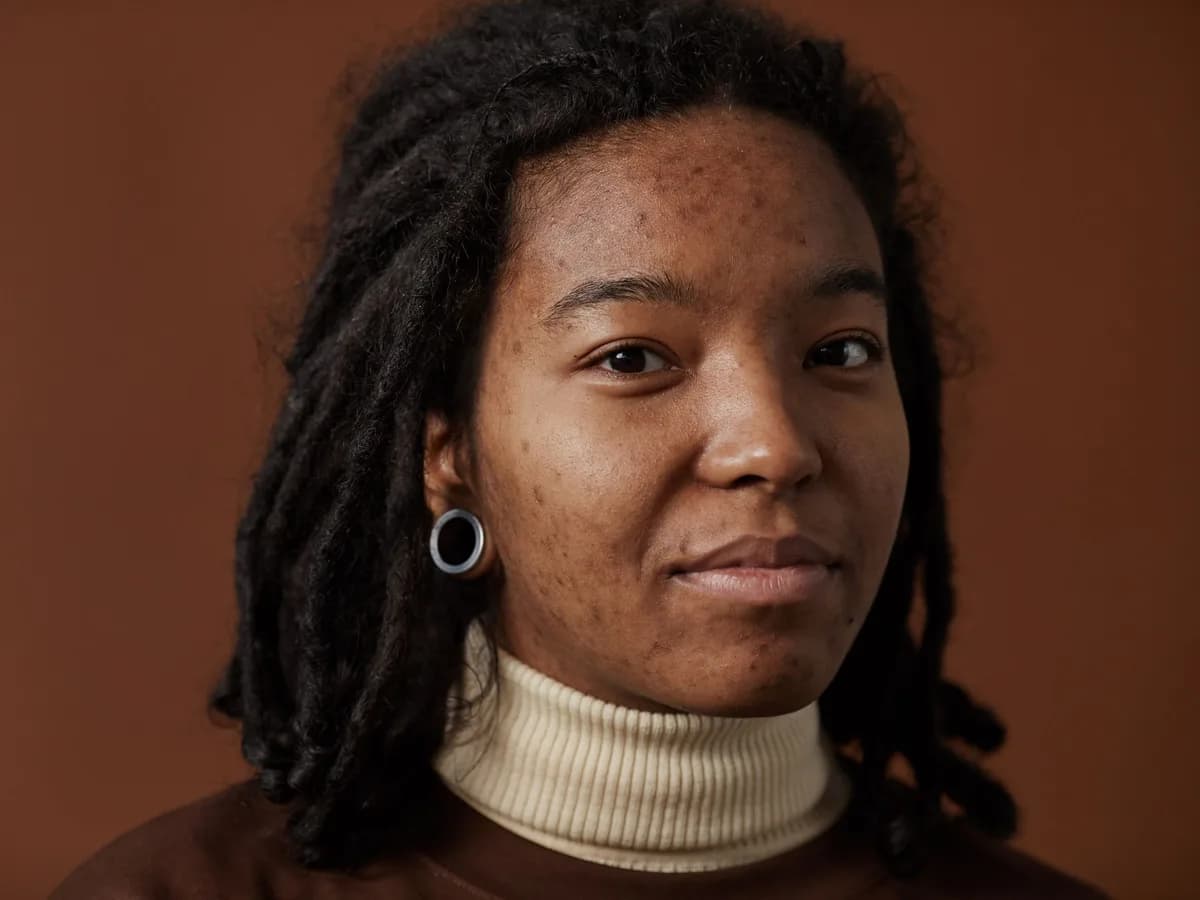 Young woman with acne on her cheeks looking at the camera
