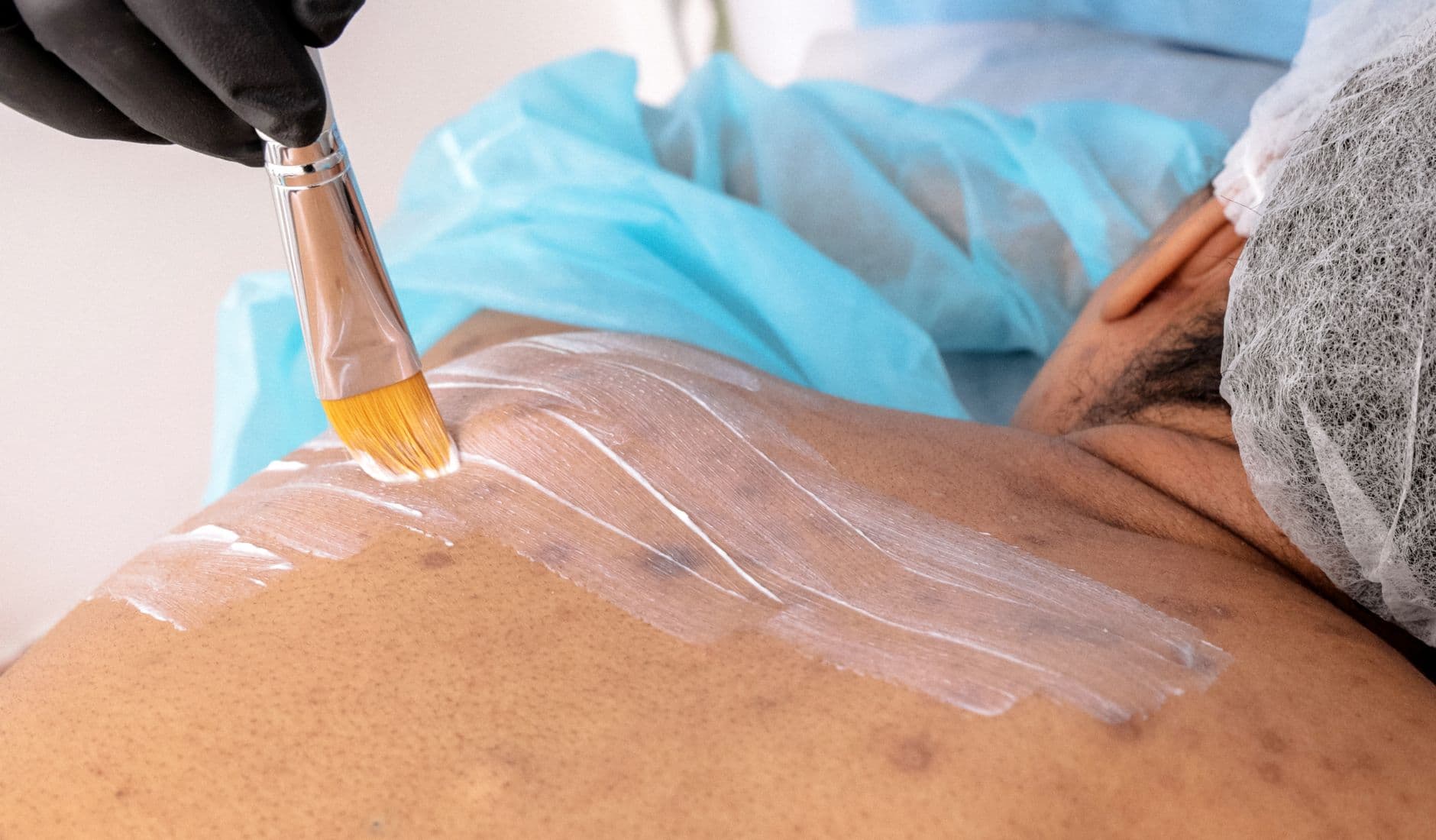 Stock photograph illustrating an article about adult acne treatment in pune